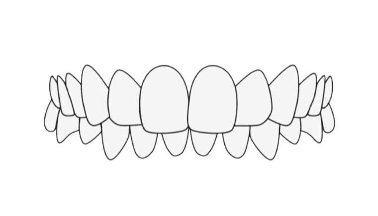 Überbiss korrigieren (ohne Hintergrund)